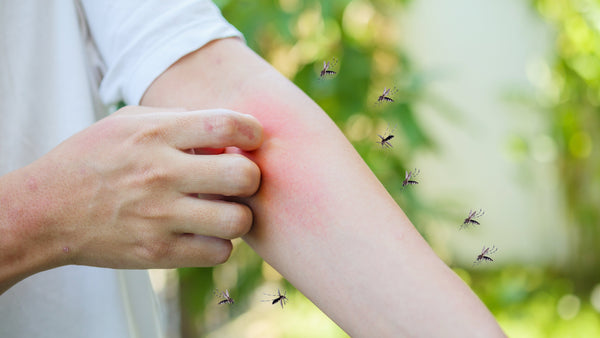 Mückenstiche bei einer Histamin-Intoleranz